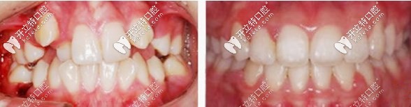 正畸前后對(duì)比
