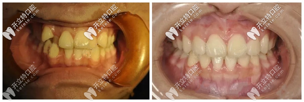 矯牙前后對(duì)比