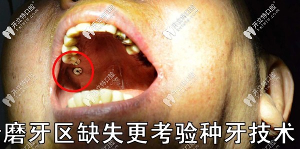 磨牙區(qū)缺失更考驗(yàn)種植牙技術(shù)