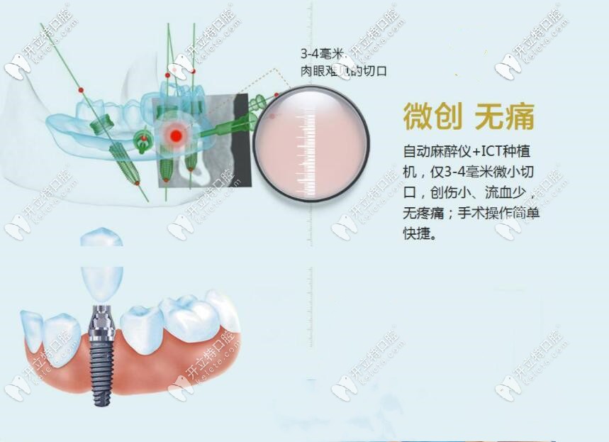 微創(chuàng)種植牙優(yōu)勢