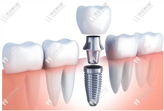 韓國(guó)奧齒泰種植牙