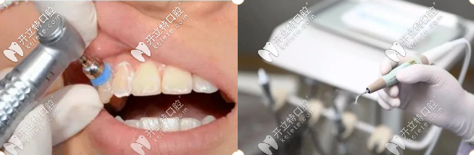 潔牙、牙修復等立減價格