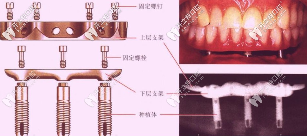 即刻負(fù)重種植牙靠譜嗎？和常規(guī)種植牙相比哪個(gè)好？