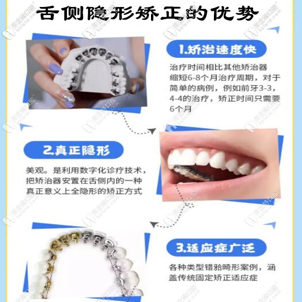 舌側(cè)隱形矯正的優(yōu)勢