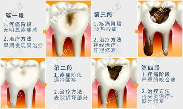山東棗莊補(bǔ)牙類型的價格