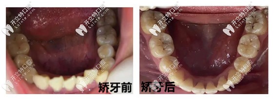 矯牙前后對(duì)比