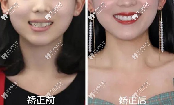 哇~22歲重度齙牙的我做了正雅日夜版隱形矯正竟然逆襲！
