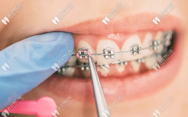 陽泉牙齒矯正收費(fèi)參考
