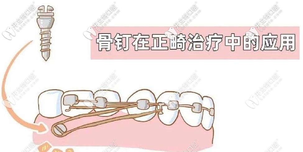 打骨釘?shù)耐锤? border=