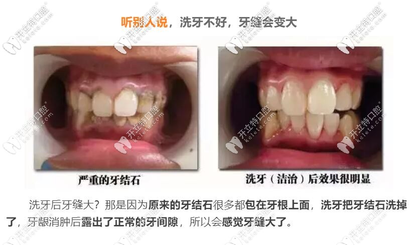 洗牙牙縫會變大嗎