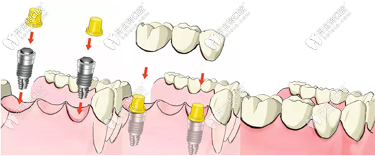 陽(yáng)江種植牙價(jià)格