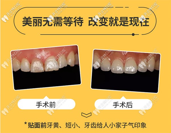 為美發(fā)問：重慶渝中區(qū)的美奧口腔做美加超薄牙貼面如何？