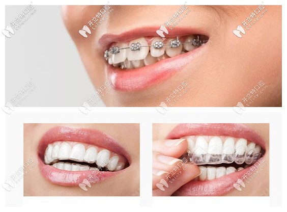 鋼牙套和隱形牙套