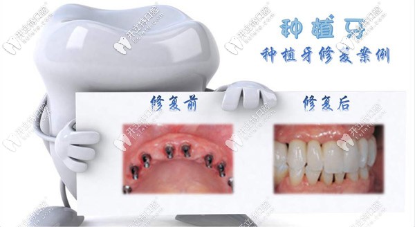 在菏澤做種植牙多少錢(qián)一顆？