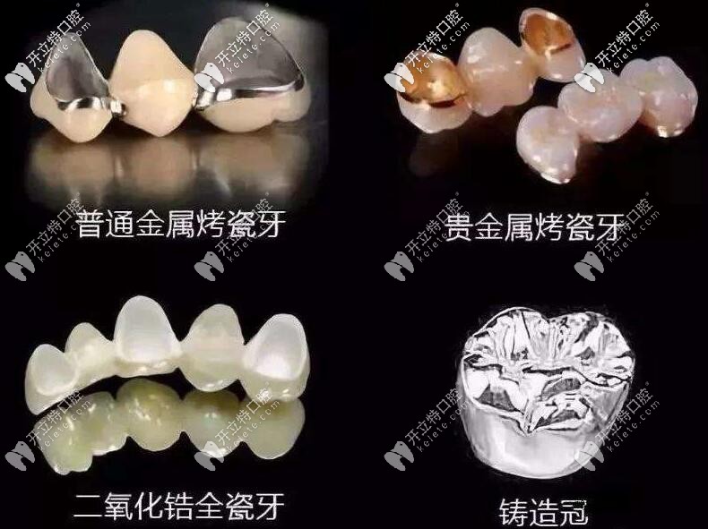 假牙的類(lèi)型