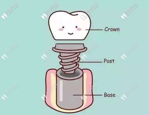 廣州越秀區(qū)中家醫(yī)口腔的種植牙價(jià)格