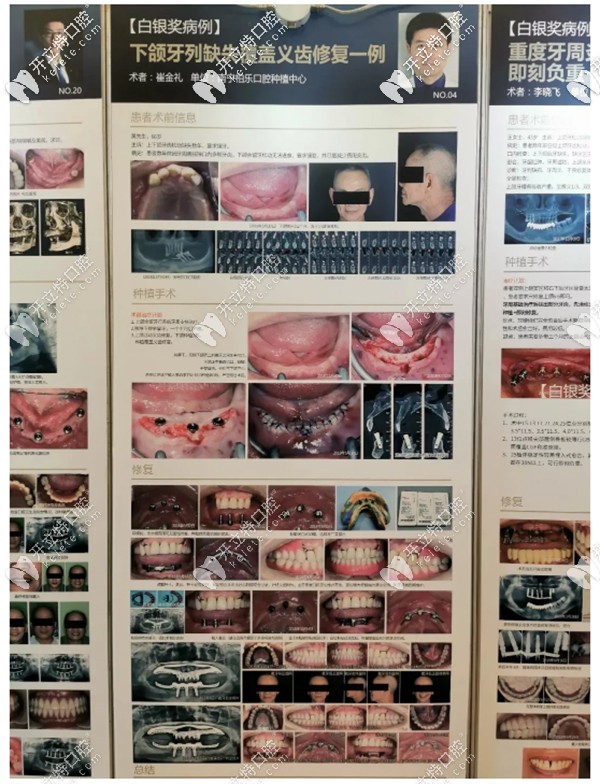 下頜牙列缺失覆蓋義齒修復