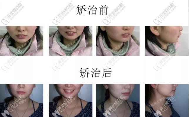 兔牙小妹妹--牙齒矯正對比圖