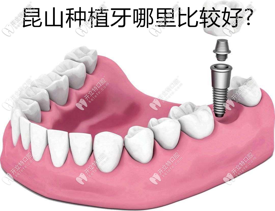 昆山種植牙哪里比較好?有木有種牙醫(yī)院排名和價格表可撩