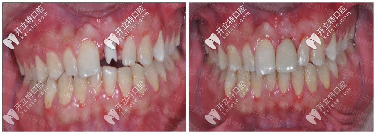 單顆種植牙修復<span style=