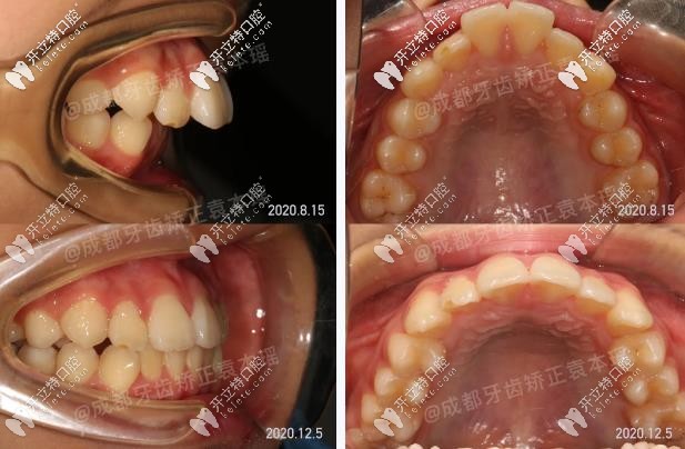 小朋友齙牙的前后矯正對比