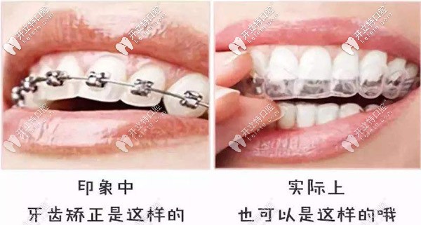 告別鋼牙妹，別錯過隱形矯正哦
