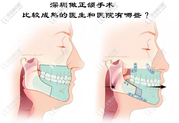 深圳正頜手術(shù)比較成熟的醫(yī)生和醫(yī)院有哪些