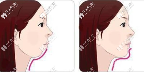 A6隱形牙套可以打開(kāi)咬合前導(dǎo)下頜