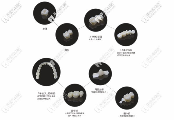 牙冠的種類及價(jià)格