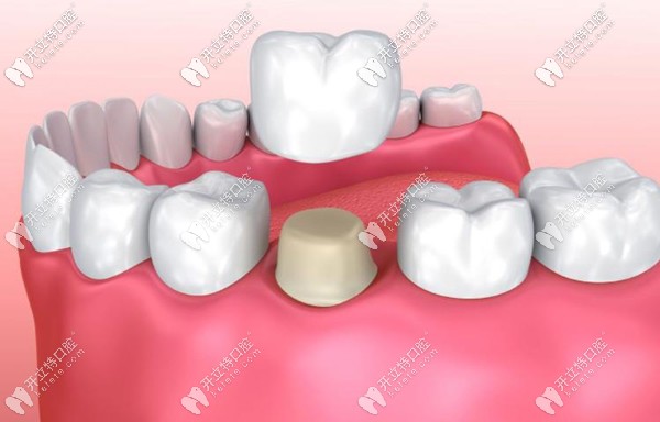 全瓷牙是否價(jià)格越貴質(zhì)量越好？