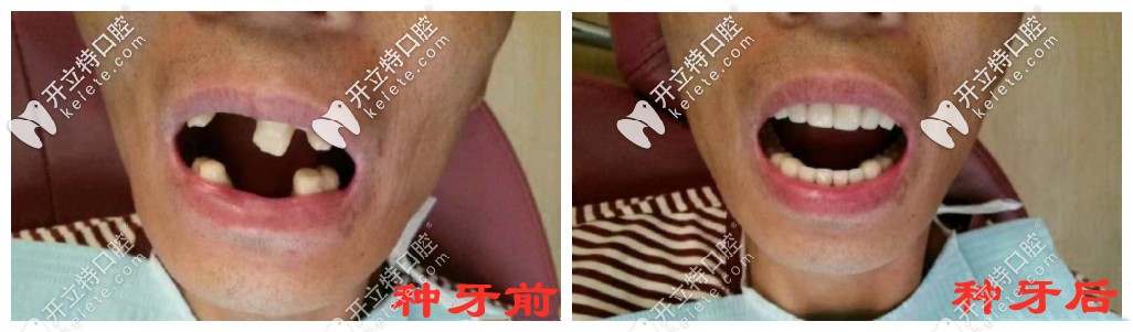種牙前后對(duì)比