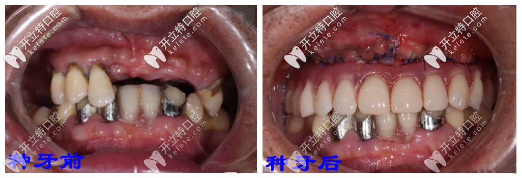 穿顴手術(shù)的種牙前后對(duì)比