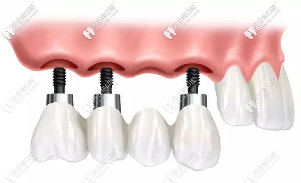 王鋒醫(yī)生尤為擅長(zhǎng)牙齒種植技術(shù) 王鋒醫(yī)生尤為擅長(zhǎng)牙齒種植技術(shù)