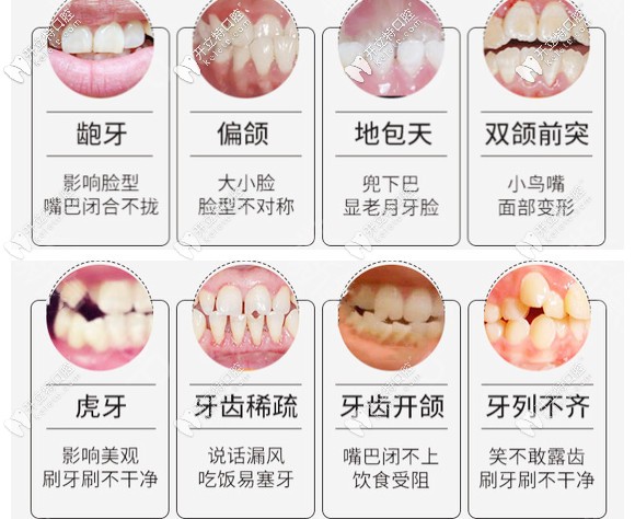 需要矯牙的幾種癥狀