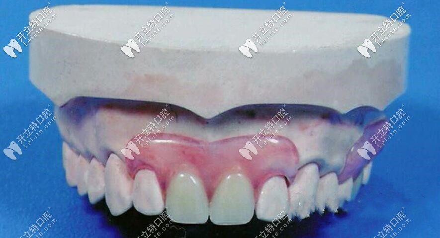 我老爸當(dāng)初用的就是類似下邊的這個(gè)義齒