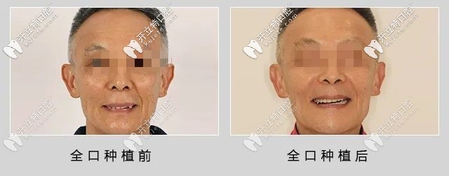 種植牙前后對(duì)比