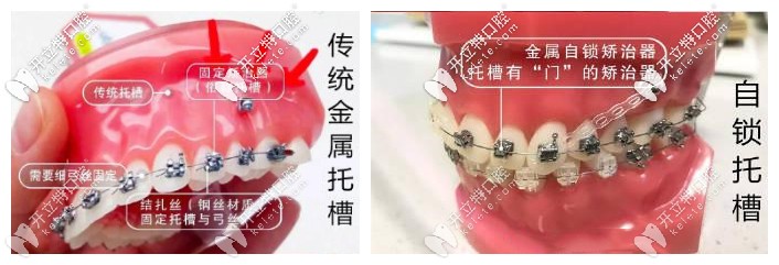 傳統(tǒng)金屬托槽和金屬自鎖托槽區(qū)別