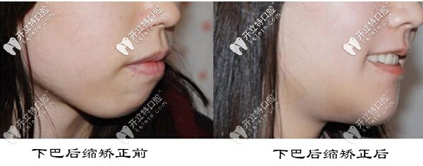 下巴后縮戴隱適美牙套矯正案例