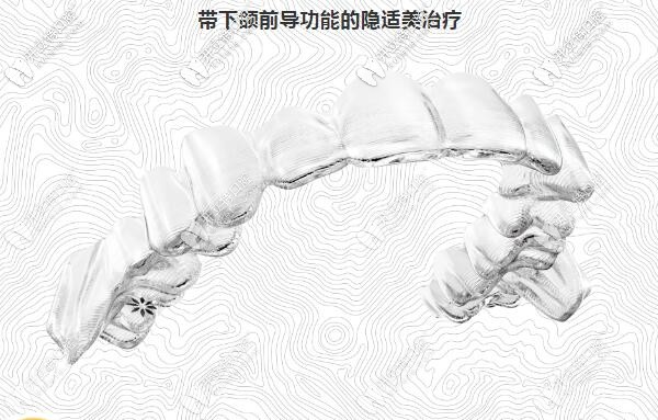  隱適美矯正下頜后縮有用嗎?據(jù)說Invisalign有帶下頜前導(dǎo)功能