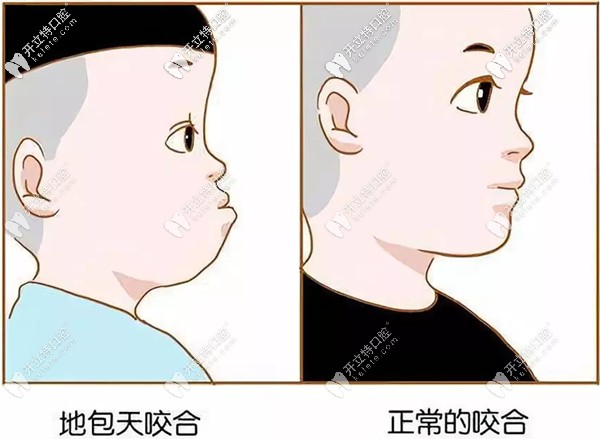 地包天和正常的面型對比圖