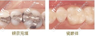 傳統(tǒng)補牙和嵌體補牙圖片