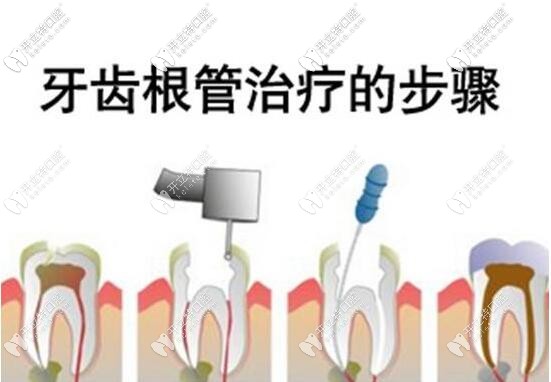 二次根管治療很麻煩,你一定要重視的根管治療失敗后的表現(xiàn)!