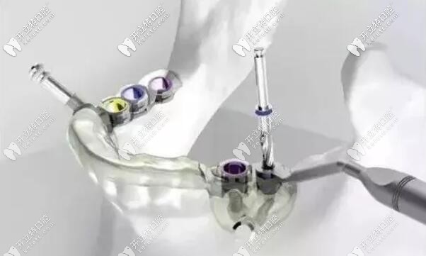 韓國奧齒泰種植牙導(dǎo)板的優(yōu)勢