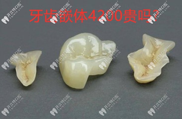 牙齒嵌體4200貴嗎?只能說嵌體補牙材質(zhì)不同價格也有差異哦