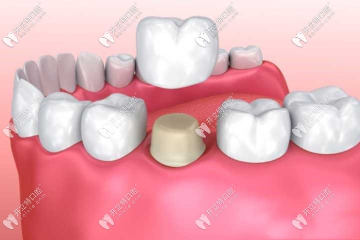 牙冠修復圖解