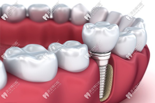 貴陽(yáng)種植牙的價(jià)格