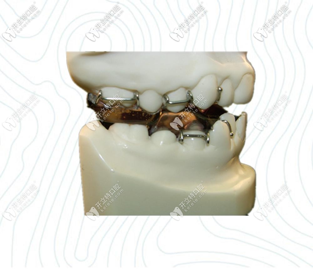 快來看看twinblock矯治原理，這些注意事項(xiàng)可是很重要哦！