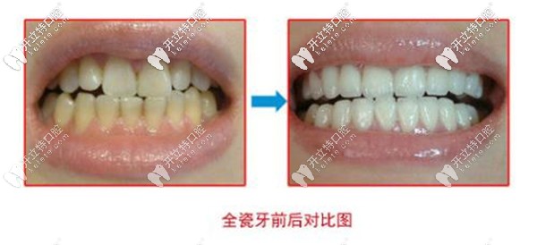 全瓷牙前后對比圖