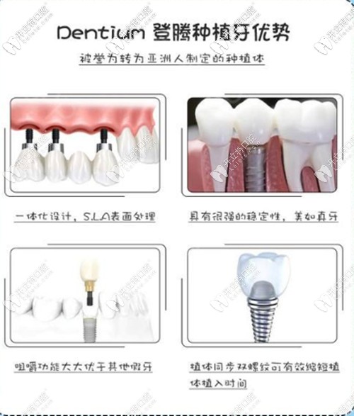韓國(guó)登騰種植牙優(yōu)勢(shì)