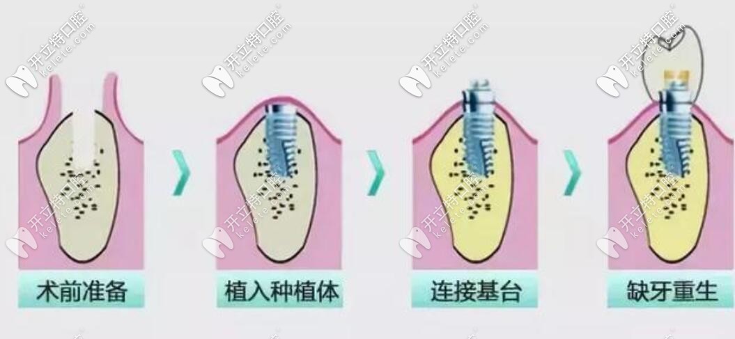 種植牙過(guò)程